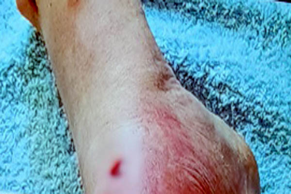 Read more about the article 일본, 연쇄상구균 독성쇼크증후군 STSS  비상 .. 증상 및 예방대책은? 